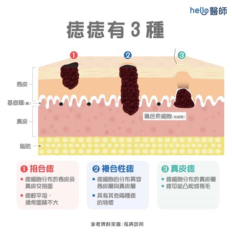 痣中痣|為什麼臉上的痣越來越多？皮膚科醫師解析長痣原因、。